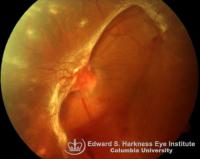 Neovascularization of the disc (NVD) associated with extensive fibrovascular proliferation.